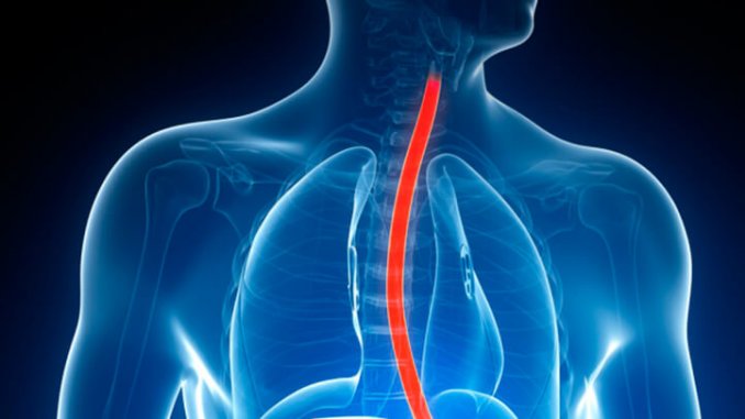 Barretts-Esophagus-722x406