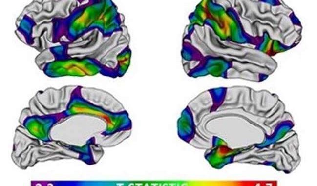 brain-volume-socioeconomic-status-3
