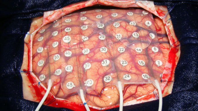 ca_0104NID_Brain_Surgery_Epilepsy_online