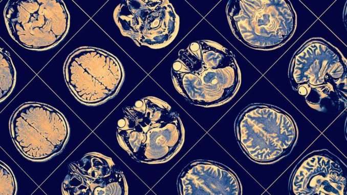 mri-brain-scan